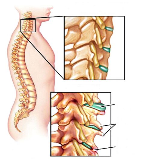 Osteokondroz nasıl görünüyor