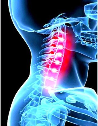 Osteokondrozun klinik resmi